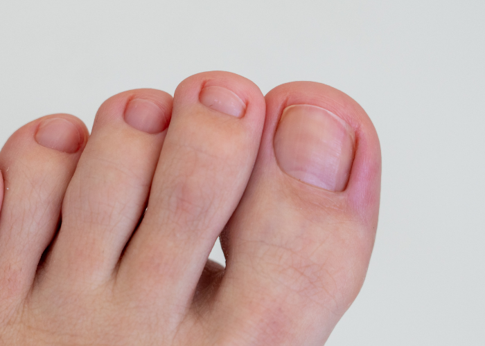 Podiatry Treatments Onsite Fungal Nail Testing Service