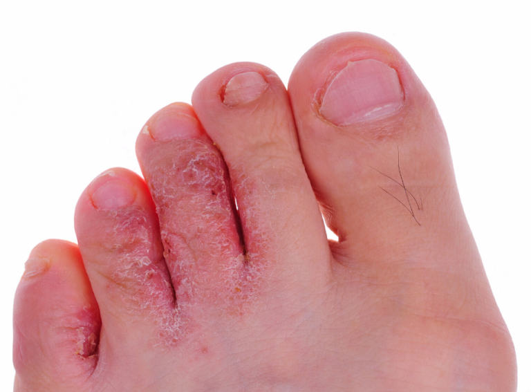 athlete’s foot treatment fungal infection
