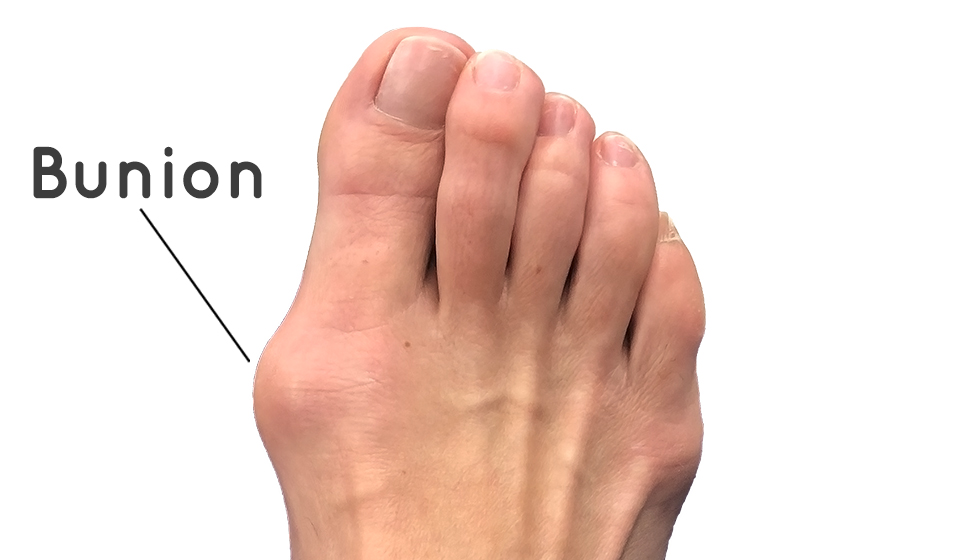 bunion treatment big toe pain