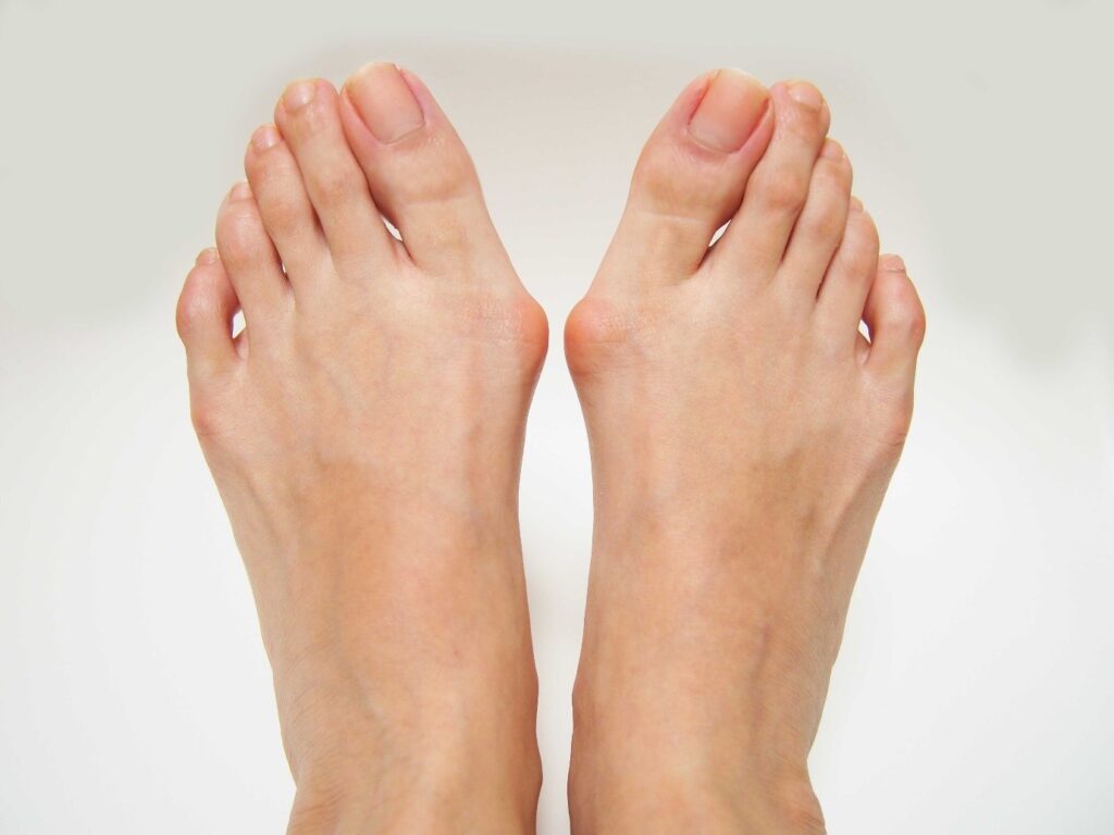 bunion foot problem