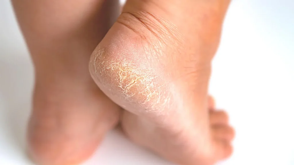 cracked heels treatment dry skin