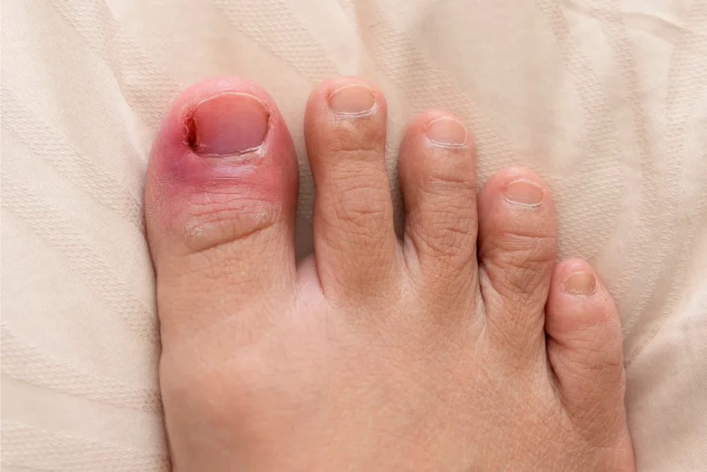 toe-pain-ingrown-nail-infection