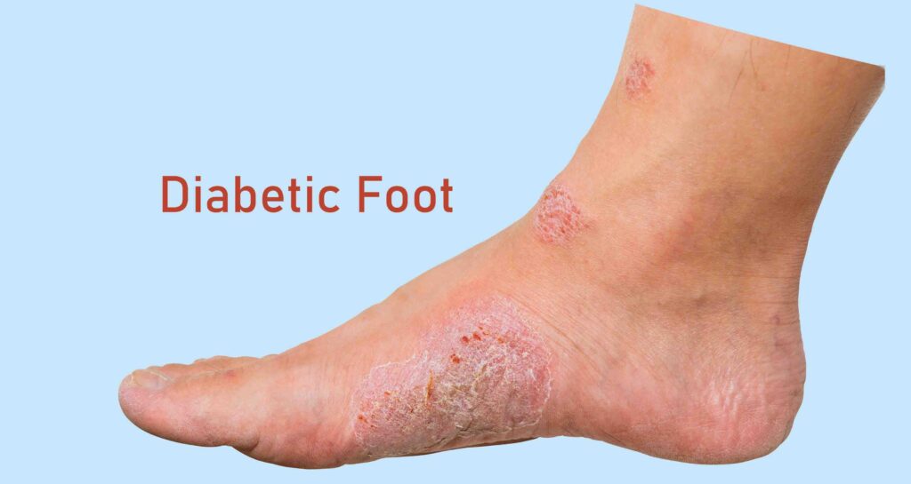 diabetic foot care daily check