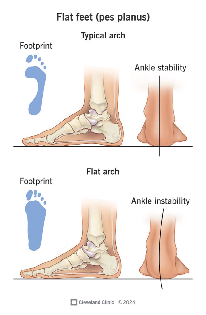 Flat feet