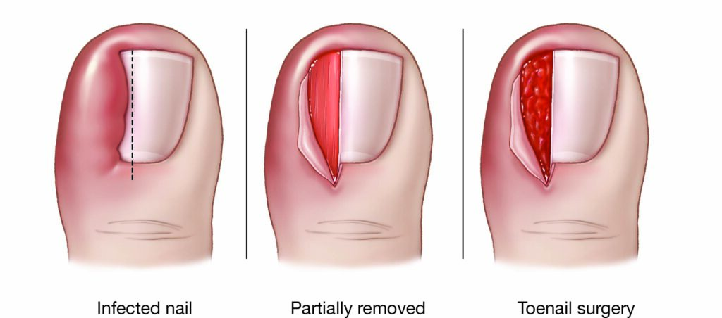 ingrown-toenail