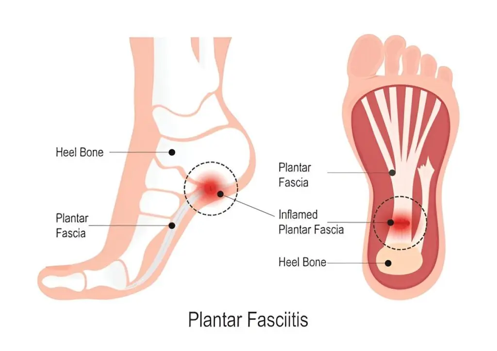plantar fasciitis treatment heel pain
