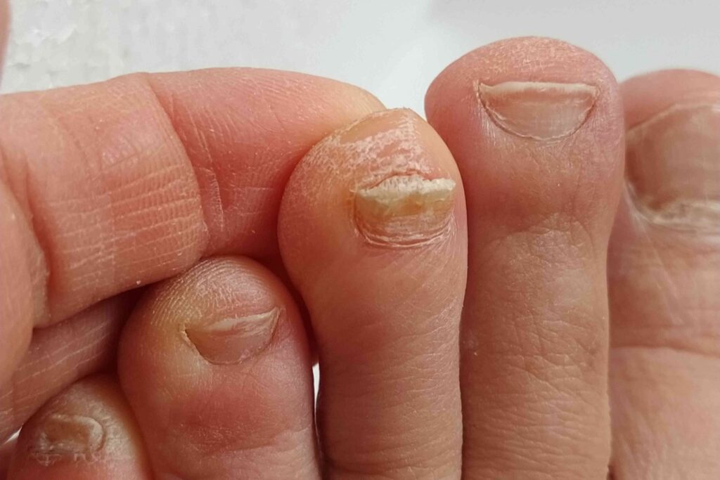toenail fungus treatment infected nail