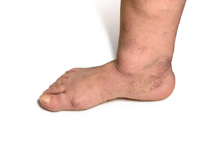 diabetic foot care routine
