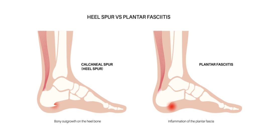 heel pain vs plantar fasciitis comparison
