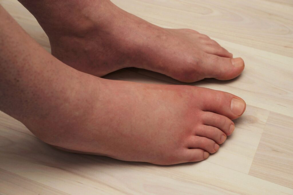 Foot swelling