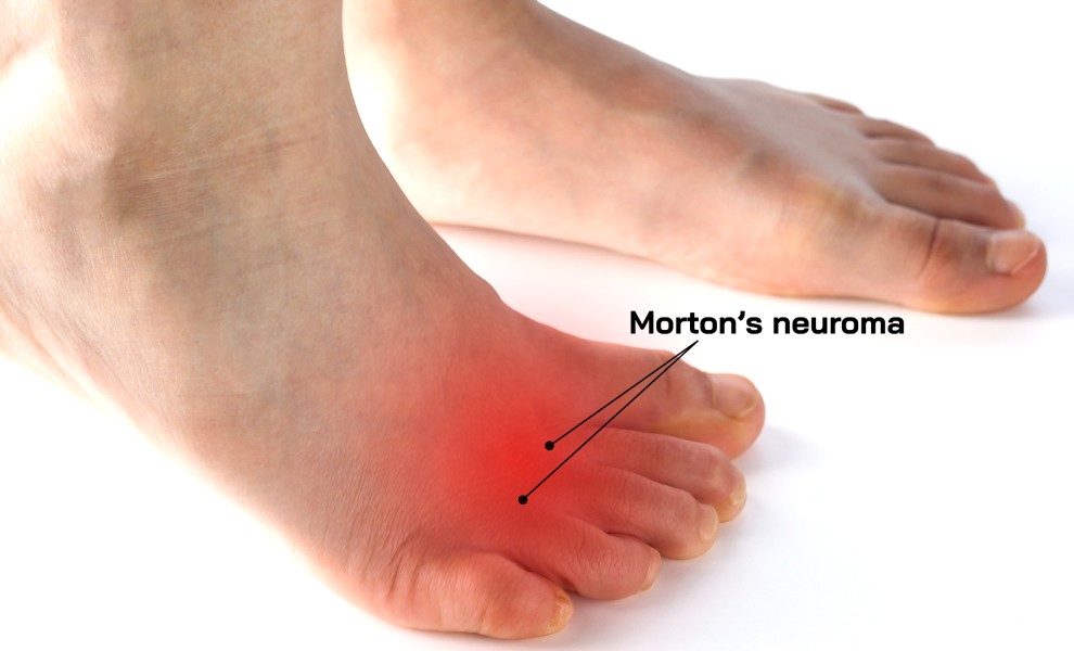 Morton's neuroma treatment