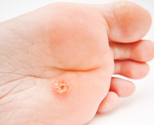 verruca prevention foot care